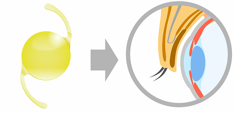 白内障などの手術で眼内レンズを挿入