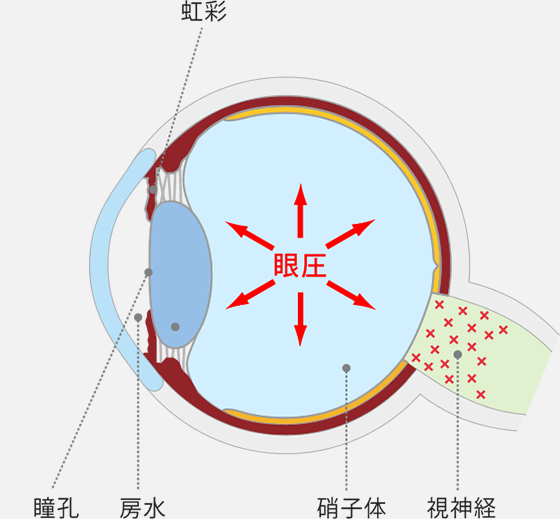 眼圧という圧力に視神経が負ける