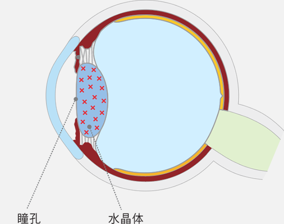 水晶体が混濁する病気