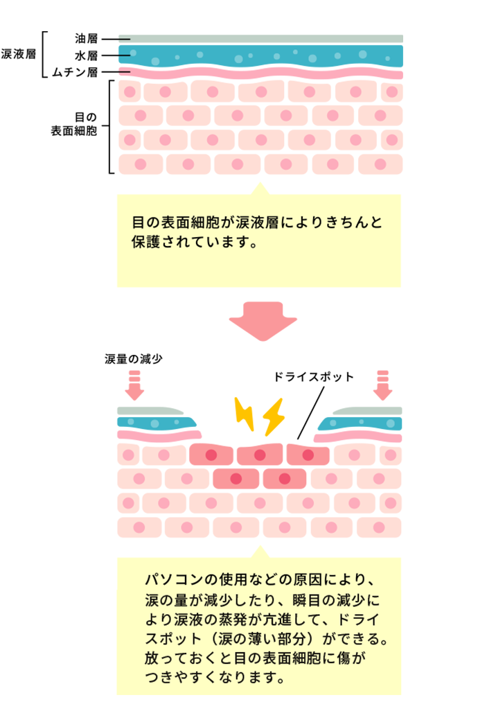 パソコンの使用などに原因により、涙の量が減少したり、瞬目の減少により涙液の蒸発が亢進して、ドライスポット（涙の薄い部分）ができる。 放っておくと目の表面細胞に傷がつきやすくなります。