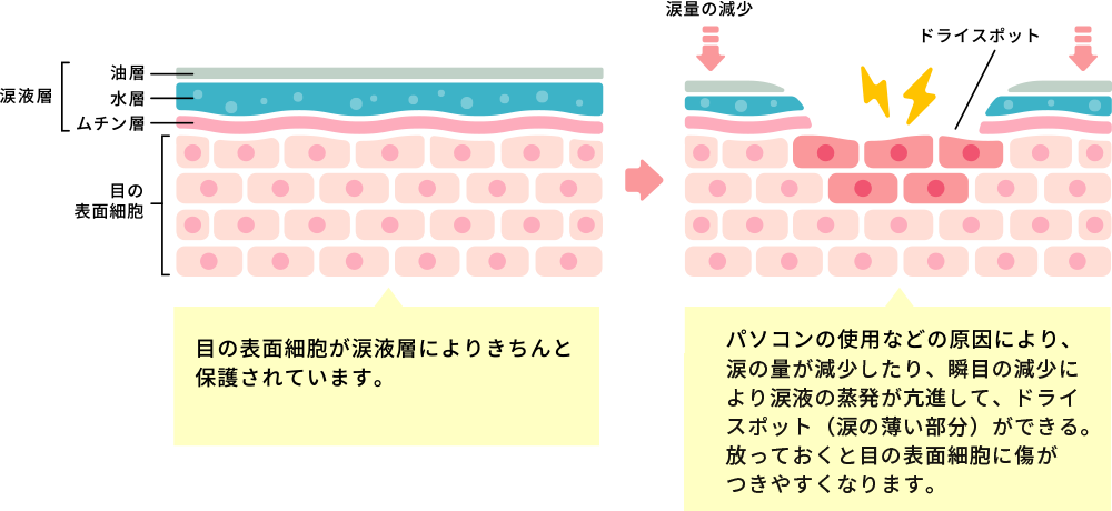 パソコンの使用などに原因により、涙の量が減少したり、瞬目の減少により涙液の蒸発が亢進して、ドライスポット（涙の薄い部分）ができる。 放っておくと目の表面細胞に傷がつきやすくなります。