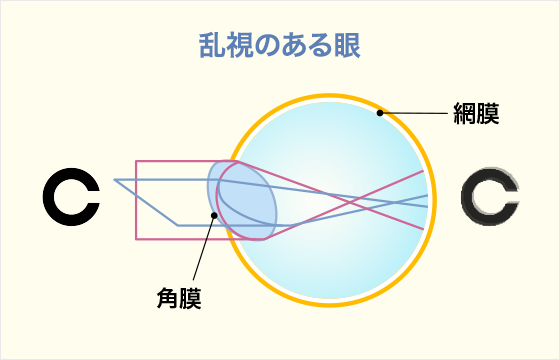 乱視のある眼