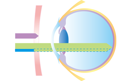 RETINEXレンズを装用した場合